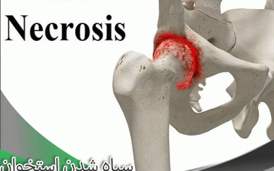 سیاه شدن استخوان