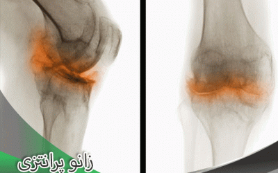تشخیص و درمان پای پرانتزی