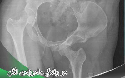 در رفتگی مادرزادی لگن درمان دارد؟