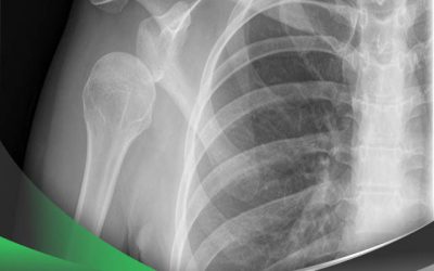 در رفتگی مفصل با چه علائمی همراه است؟