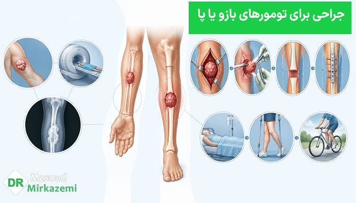 جراحی برای تومورهای بازو یا پا