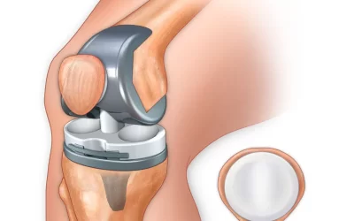 عمل تعویض مفصل زانو چیست و چگونه انجام می‌شود؟