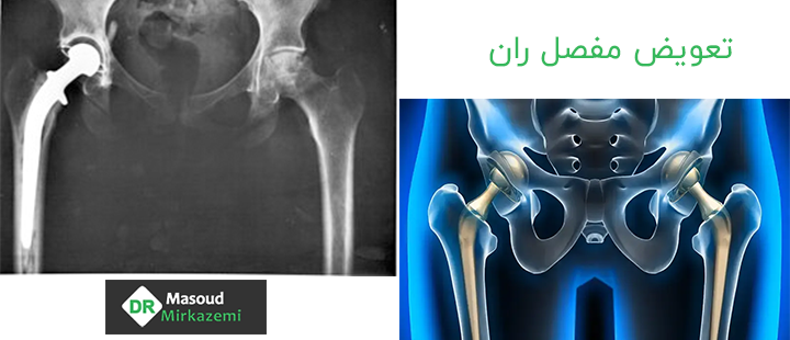 تعویض مفصل ران چگونه انجام می‌شود؟
