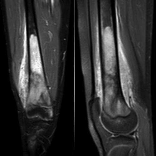 جراحه کتل الأنسجه الرخوه أو سارکوما العظام