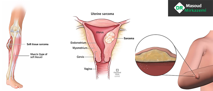 آشنایی با سرطان سارکوم