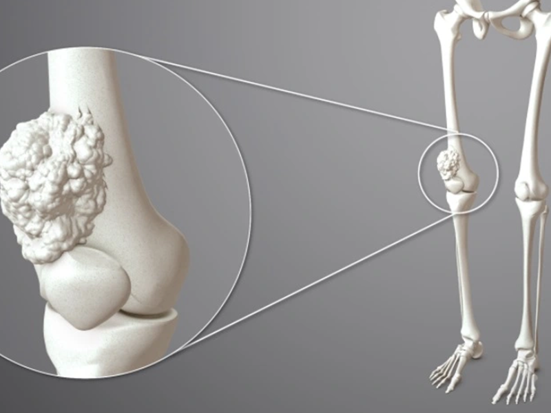 سرطان استخوان چیست و چه علائمی دارد؟