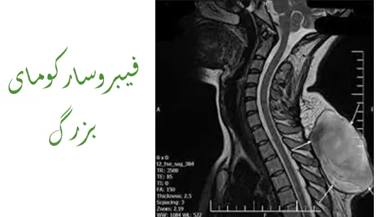 فیبروسارکوما