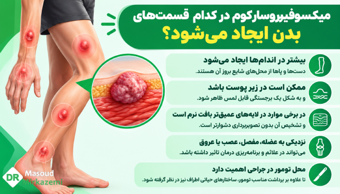 میکسوفیبروسارکوم در کدام قسمتهای بدن ایجاد میشود؟