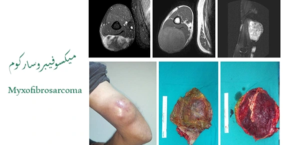 میکسوفیبروسارکوم