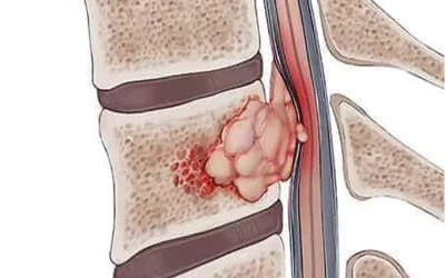 تومور استخوانی کوردوما