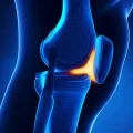 هزینه جراحی استئوتومی زانو در سال 1404