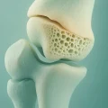 عوارض تعویض مفصل زانو