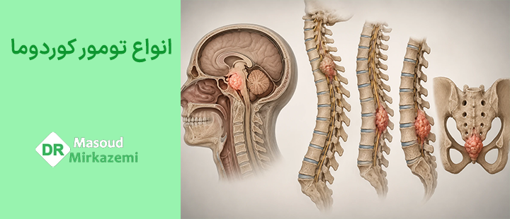 انواع تومور کوردوما